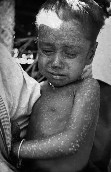 最后一位自然感染主天花病毒的患者拉希马·巴努（1975年），图片来源：wikimedia