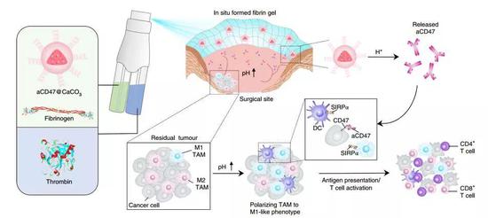  CD47抗体及碳酸钙载体包裹在纤维蛋白中，清除手术创伤部位的H+，释放CD47抗体，从而促使巨噬细胞显示M1表型，阻断肿瘤细胞“不要吃我”的信号