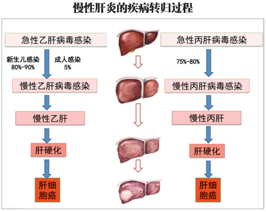 慢性肝炎的疾病转归过程 